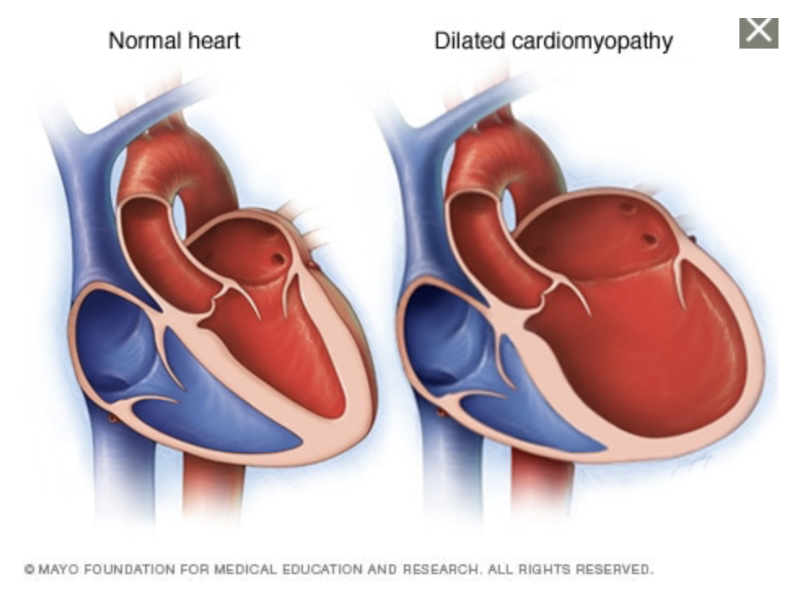 Миокард правого желудочка сердца. Дилатационная гипертрофия. Концентрическая кардиомиопатия. Дилатационная кардиомиопатия сердца. Дилатационная кардиомегалия.